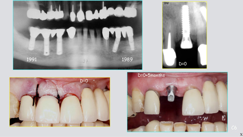 bone loss upper teeth